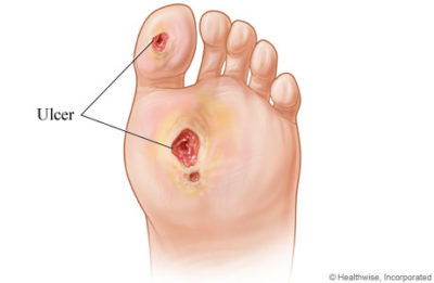 Diabetic Foot Exam