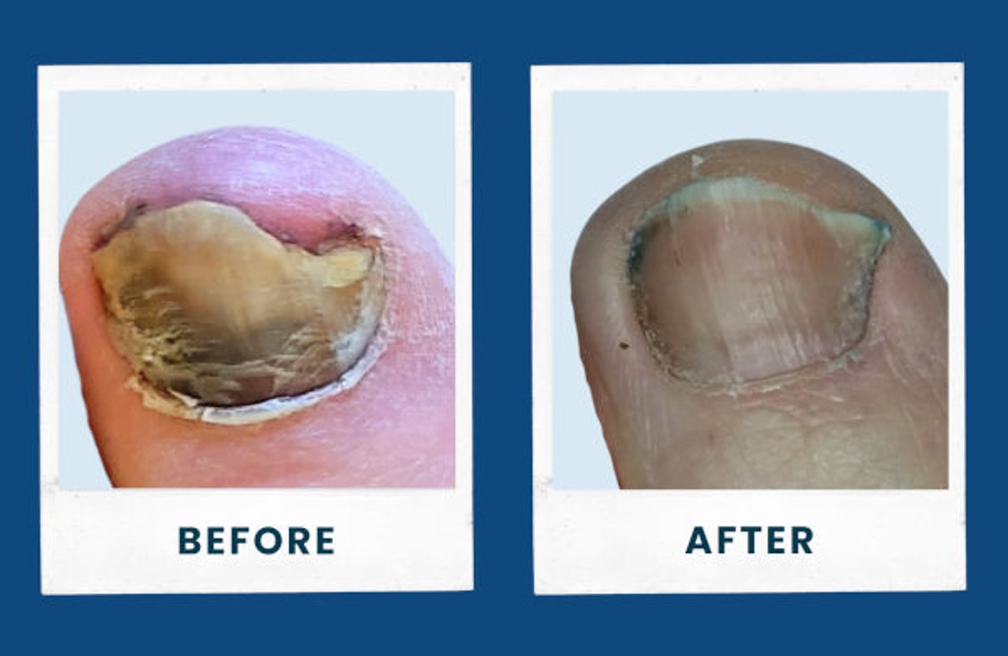Toenail Fungus can be stubborn but is very treatable.