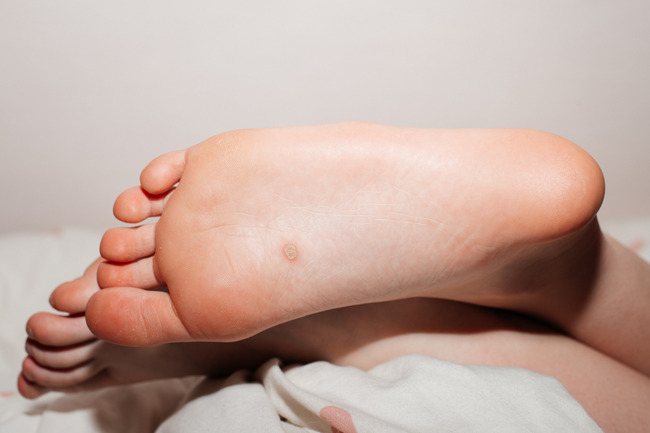 A foot with a plantar wart 