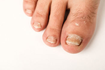 fungal nail infection