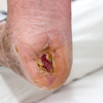 diabetic foot wound | amputation prevention