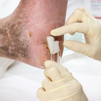 foot wound care | amputation prevention