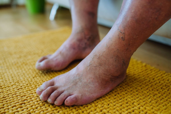 diabetic feet | amputation prevention