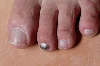 Black toenail caused by blood under the nail