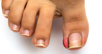 female foot with ingrown toenails