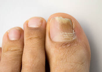 fungal nails on the foot