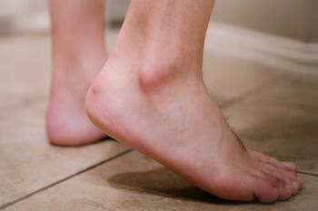 foot with a bony protrusion called haglund's deformity