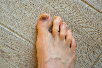 having toenail fungus on the foot