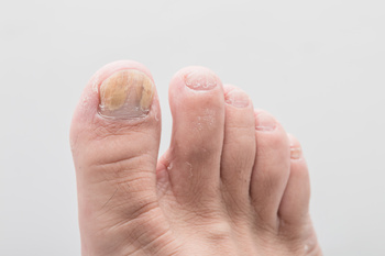 having ugly toenail on the feet