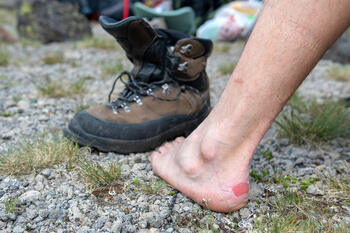 hiker got a blister on his foot