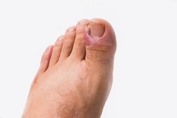 Red, swollen big toe with ingrown toenail and irritation