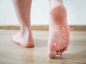 A foot with a plantar wart