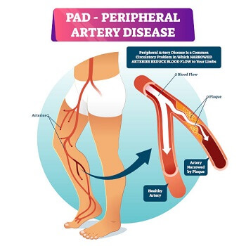 Peripheral artery disease narrowing blood flow in leg arteries