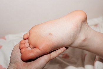 Missoula podiatrist treating a stubborn plantar wart on patient&rsquo;s foot