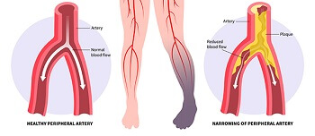 Diagram showing healthy and narrowed peripheral arteries for an ABI test