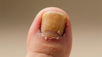 painful ingrown or thickened toenails