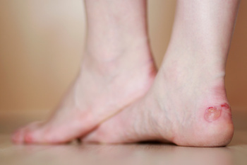 woman's feet with blister 